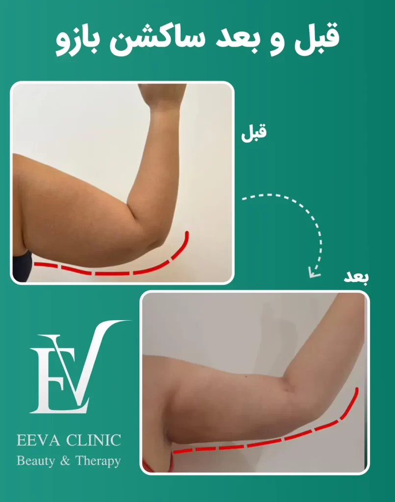 قبل و بعد ساکشن بازو