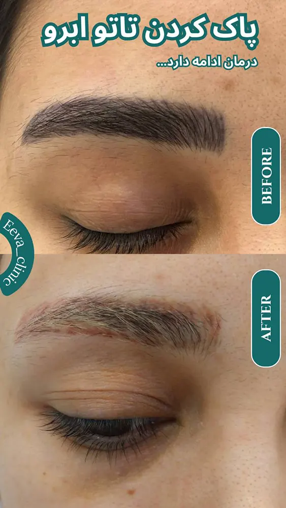 لیزر تاتو ابرو