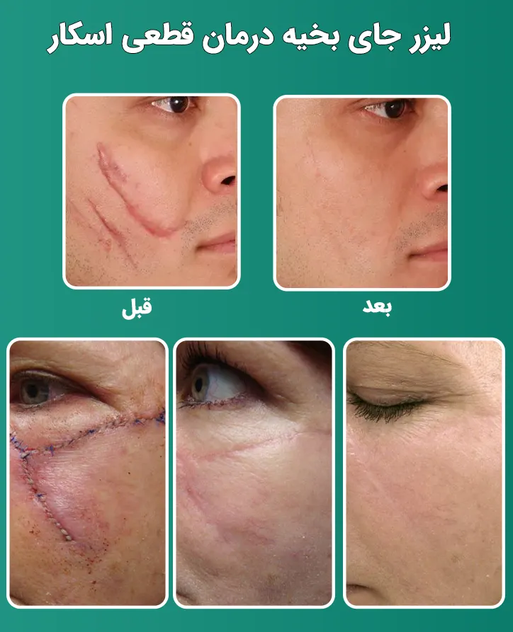 قبل و بعد لیزر جای بخیه