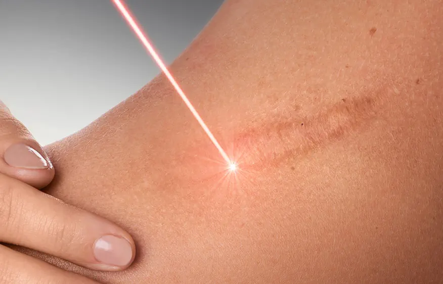 لیزر جای بخیه