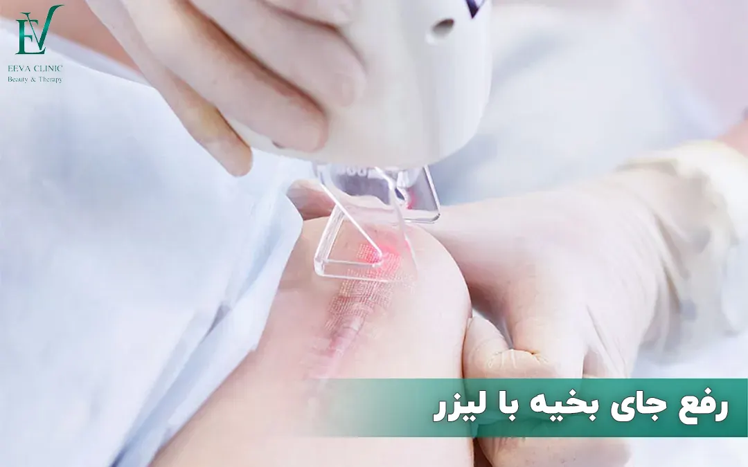لیزر جای بخیه