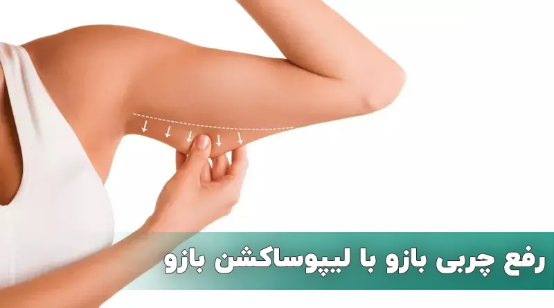لیپوساکشن بازو