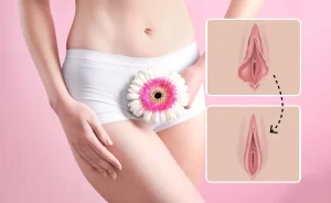 لابیاپلاستی یا عمل زیبایی واژن