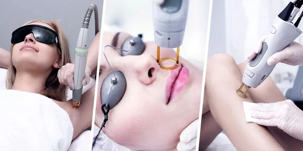 لیزر موهای زائد