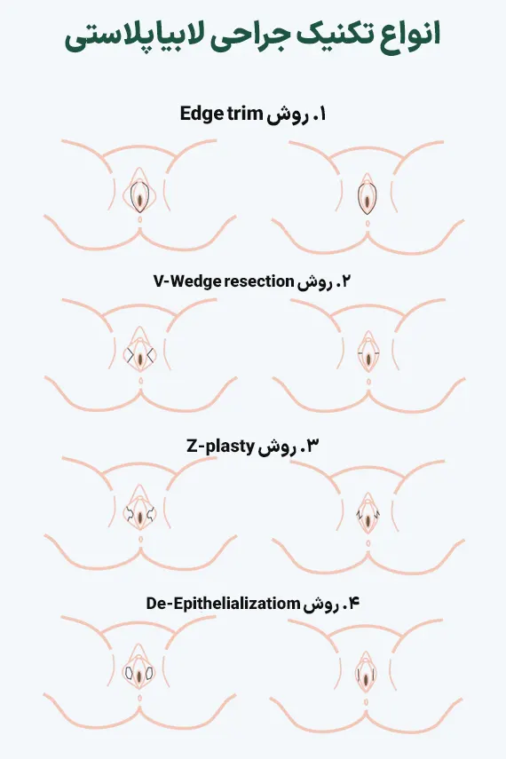 انواع تکنیک جراحی لابیاپلاستی