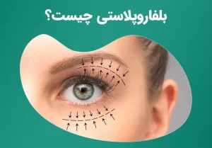 بلفاروپلاستی چیست؟