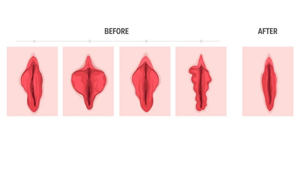 عمل لبه آویزان واژن