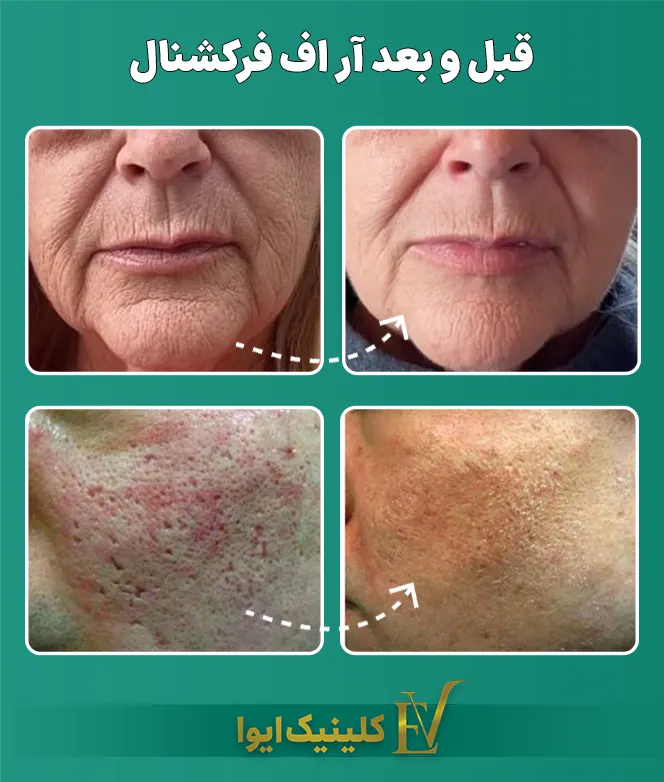 قبل و بعد آر اف فرکشنال صورت