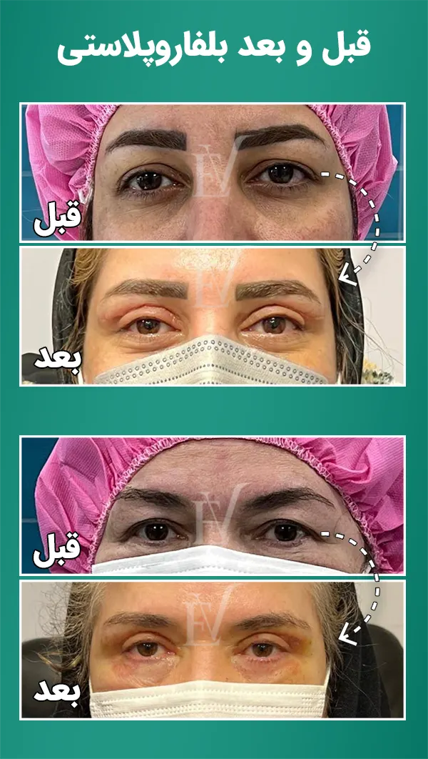 قبل و بعد بلفاروپلاستی