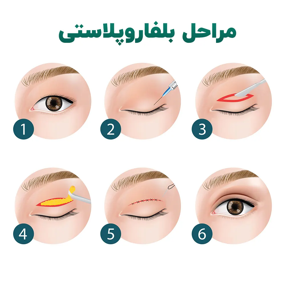 مراحل بلفاروپلاستی