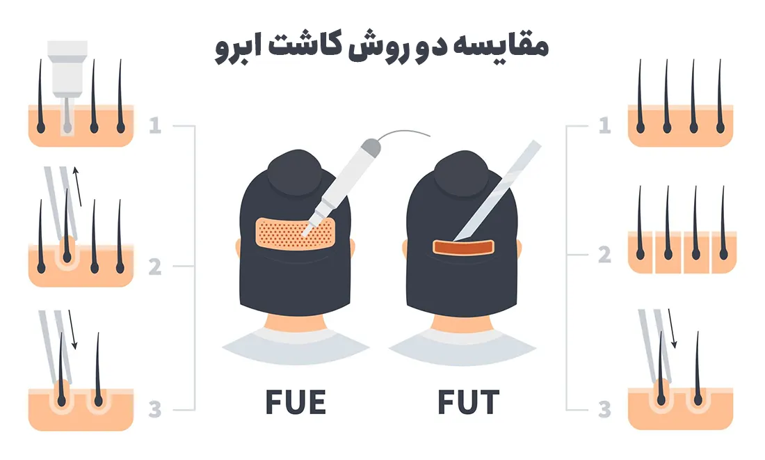 مقایسه روش های کاشت ابرو