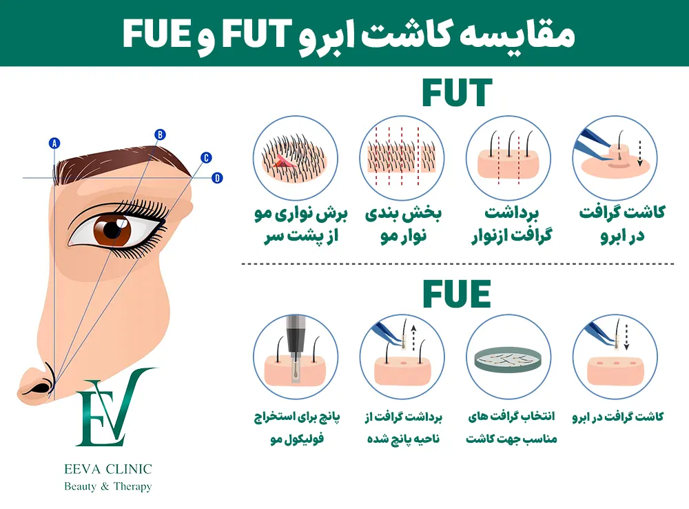 مقایسه کاشت ابرو FUT و FUE
