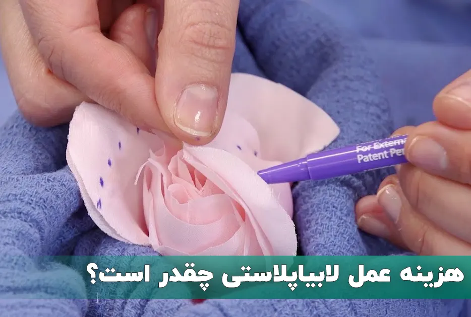 هزینه عمل لابیاپلاستی