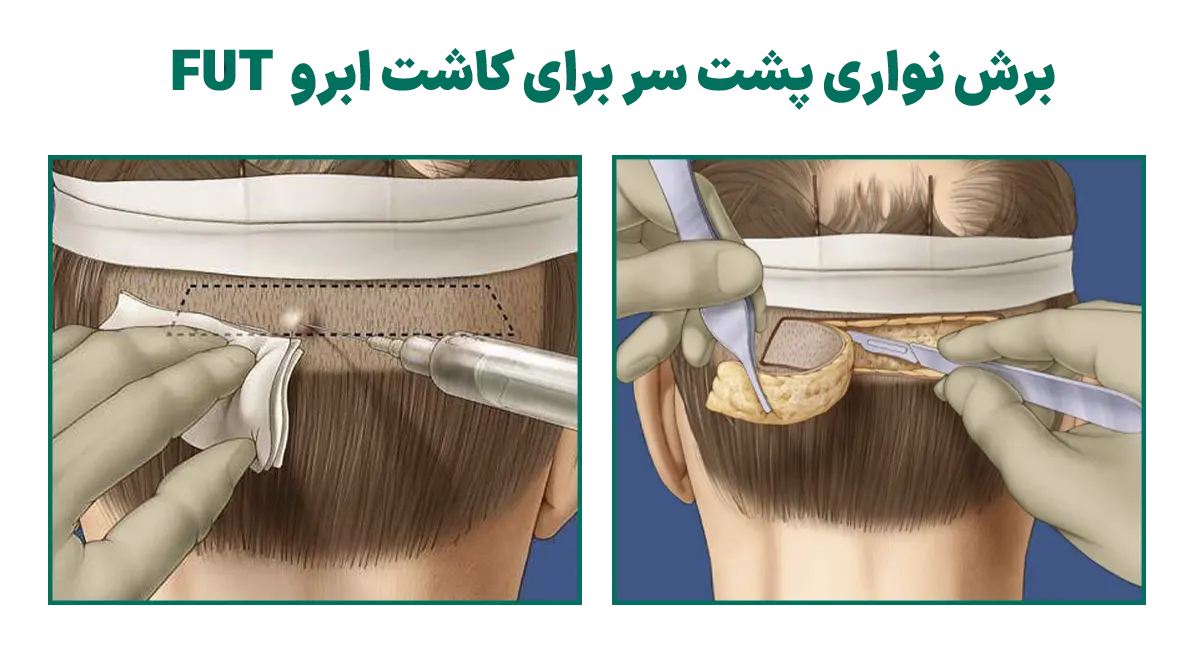 کاشت ابرو به روش FUT