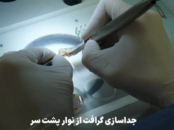 جداسازی گرافت مو