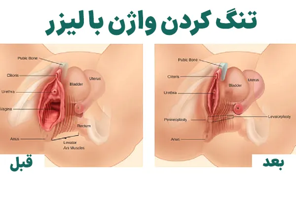 لیزر واژن بیکینی قبل و بعد