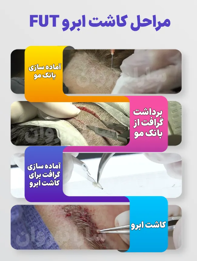 فیلم کاشت ابرو از صفر تا صد + قبل از کاشت ابرو چه داروهایی نباید خورد