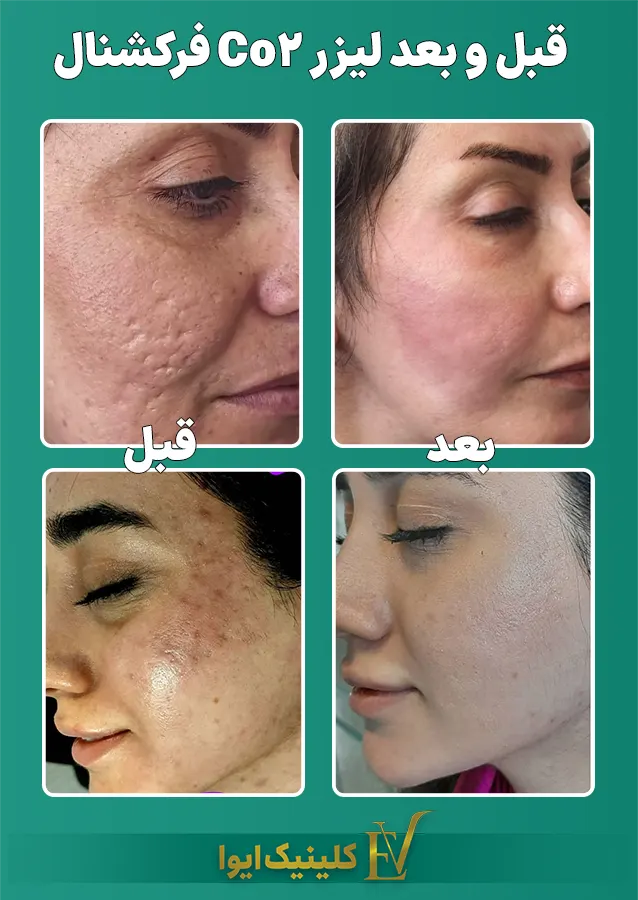 قبل و بعد لیزر فرکشنال