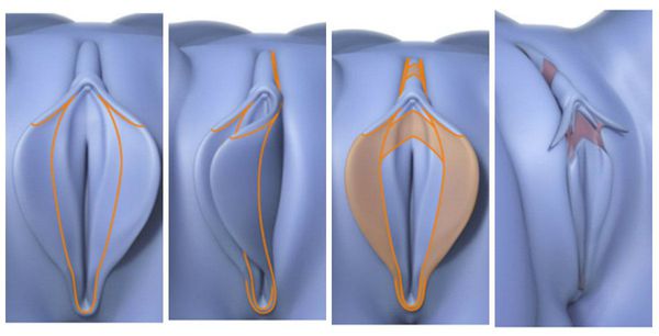 عمل لابیاپلاستی