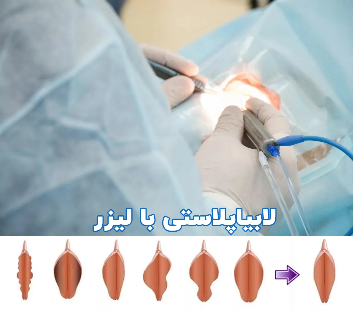 عمل لابیاپلاستی با لیزر