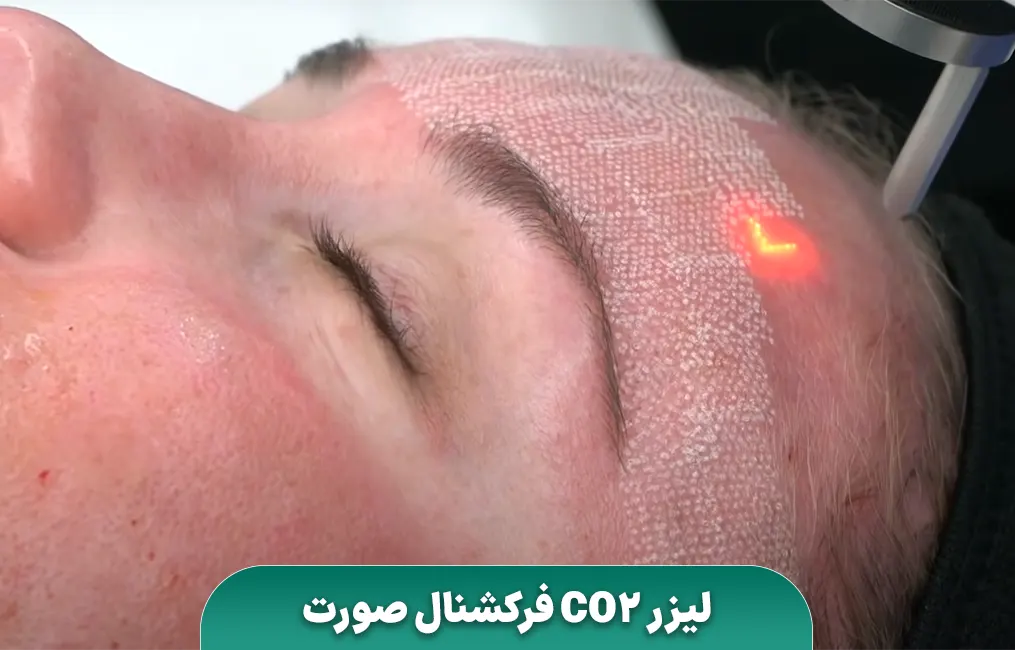 لیزر CO2 فرکشنال