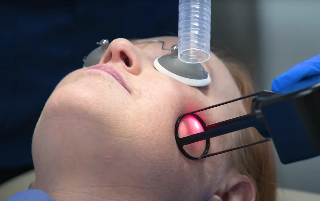 هزینه لیزر فرکشنال