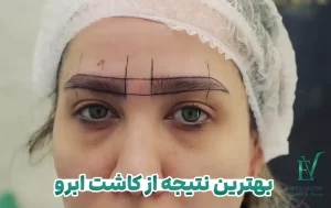 بهترین نتیجه از کاشت ابرو