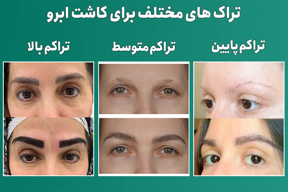 تراک های مختلف برای کاشت ابرو