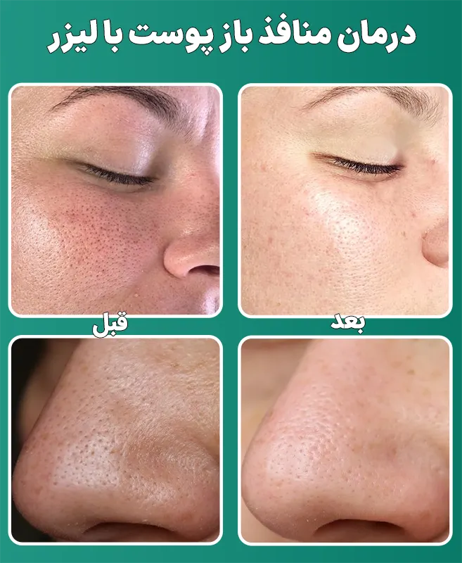 درمان منافذ باز پوست با لیزر فرکشنال