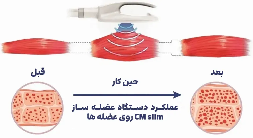 عضله سازی با دستگاه CM SLIM چگونه است؟