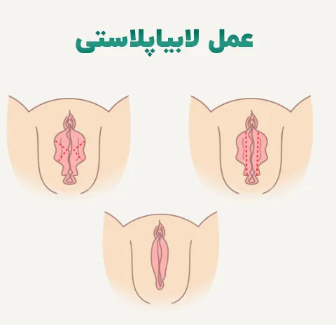 عمل لابیاپلاستی