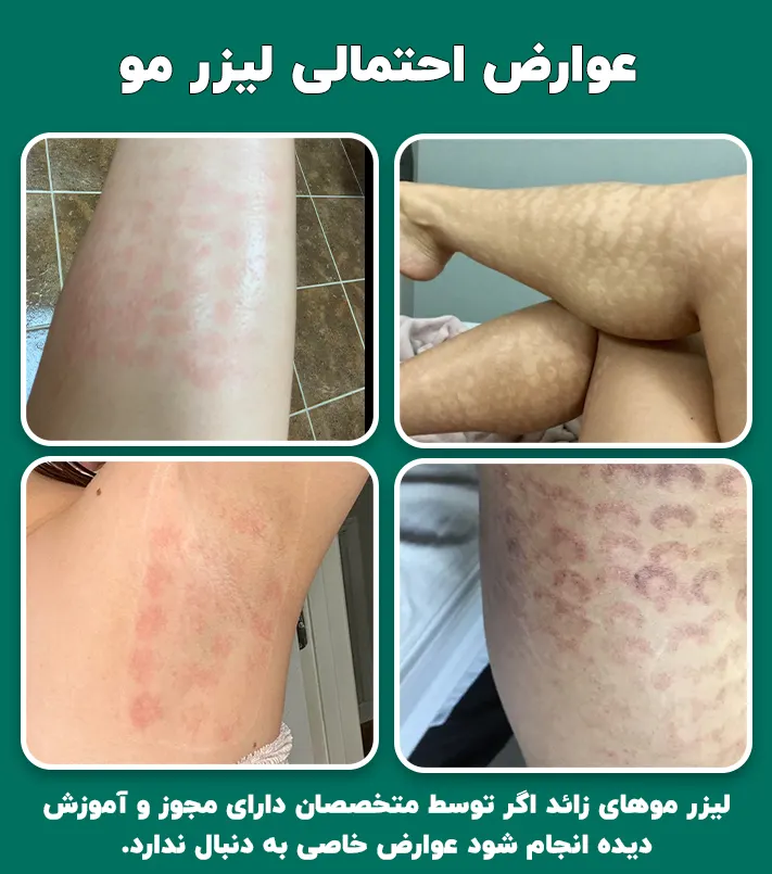 عوارض احتمالی لیزر مو زائد