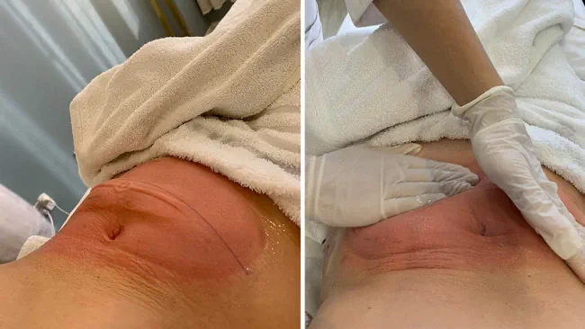 عوارض دستگاه چربی سوز