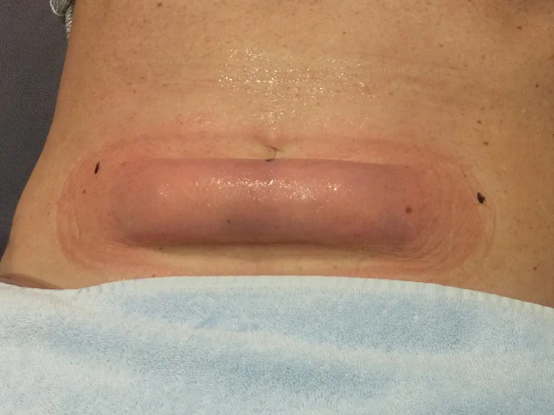 عوارض دستگاه چربی سوز شکم