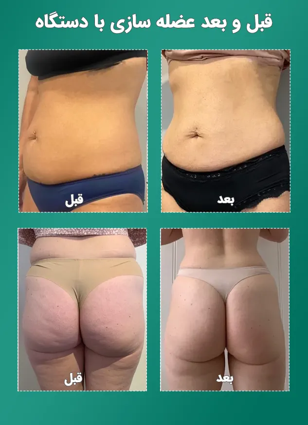 قبل و بعد عضله سازی با دستگاه