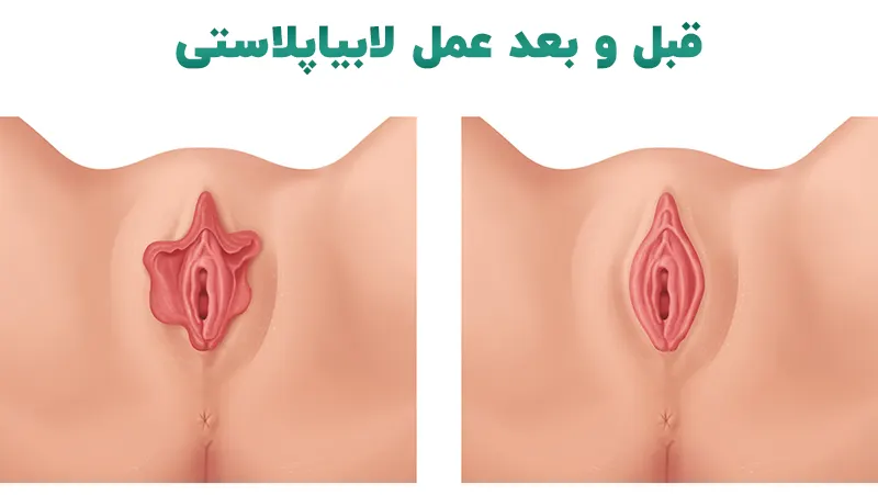 قبل و بعد عمل لابیاپلاستی