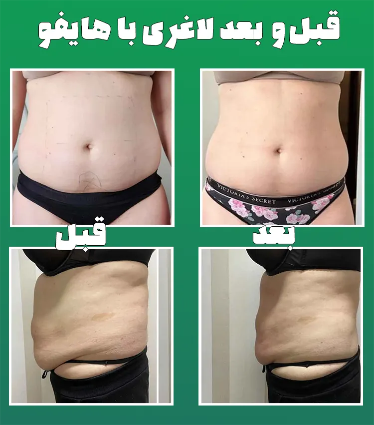 قبل و بعد لاغری با هایفو