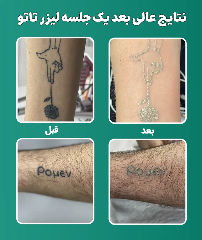 قبل و بعد لیزر تاتو بدن