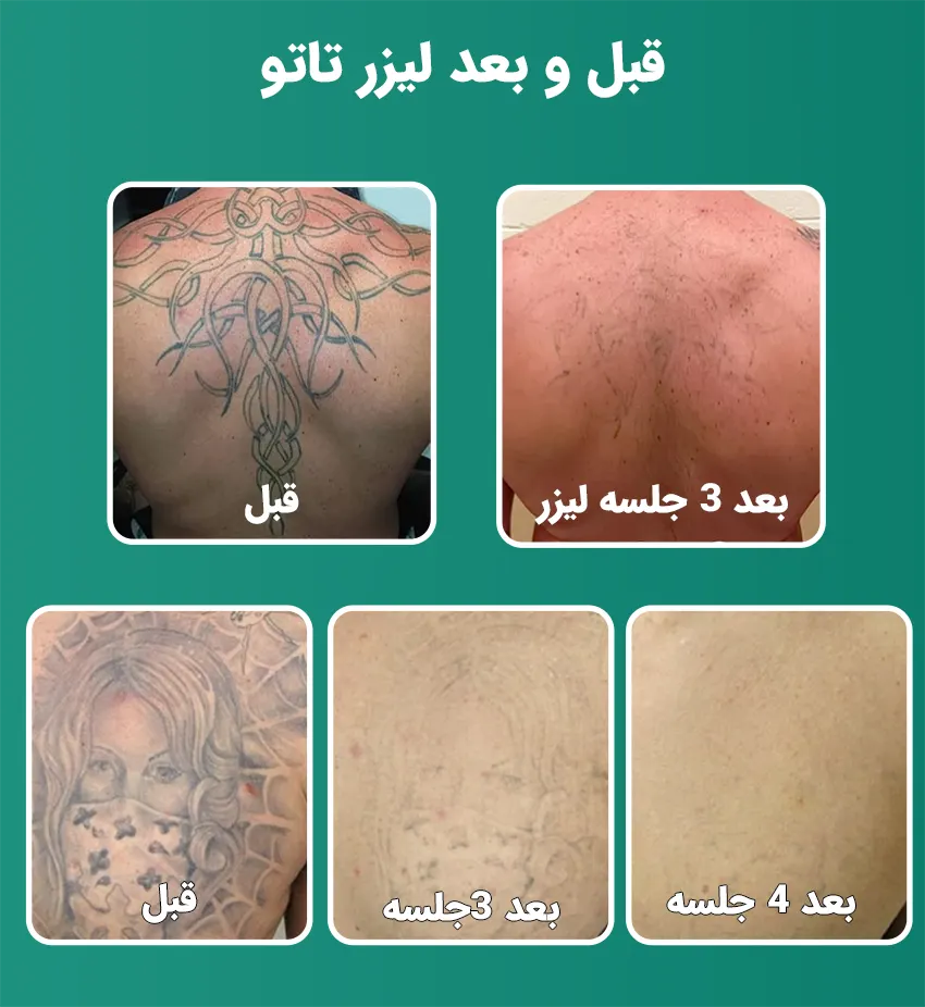 قبل و بعد لیزر تاتو