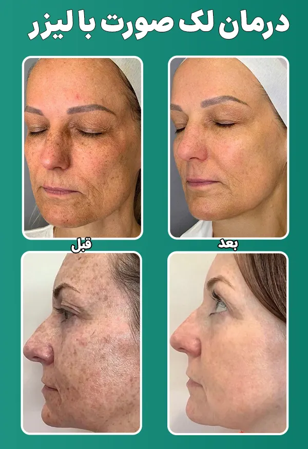 قبل و بعد لیزر لک صورت