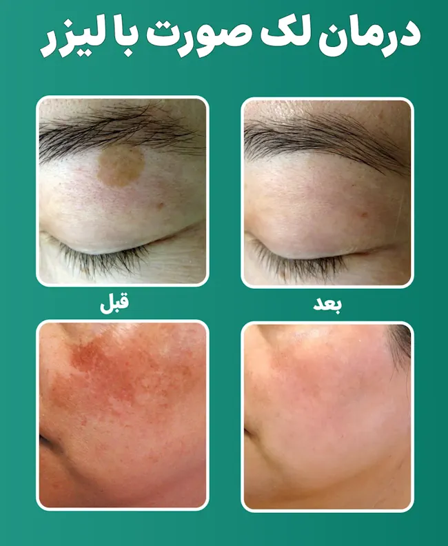 قبل و بعد لیزر لک