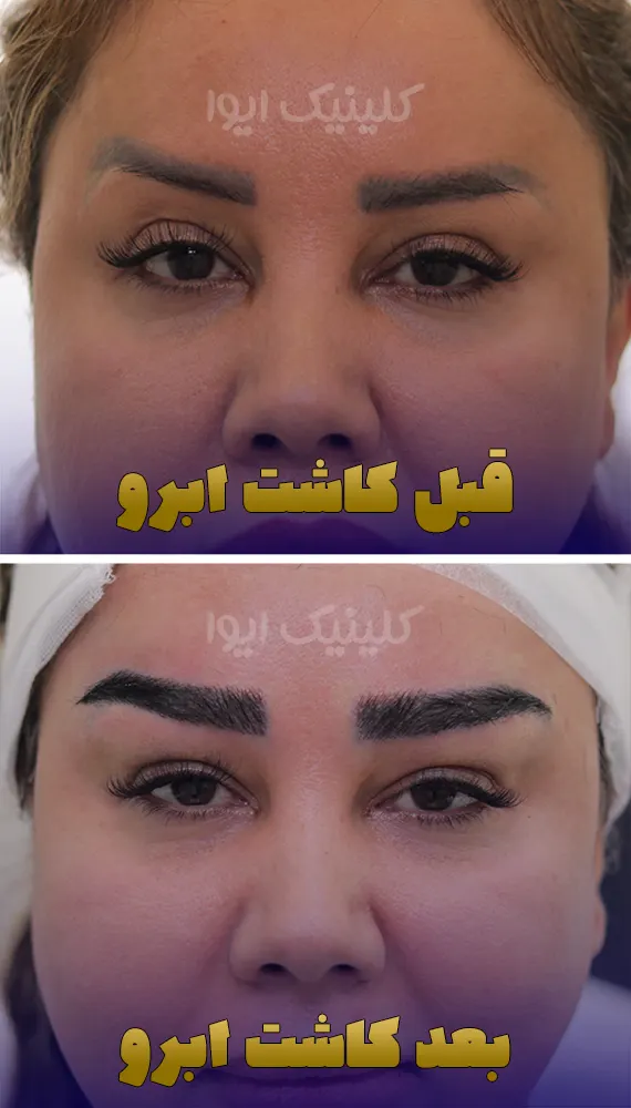 قبل و بعد کاشت ابرو