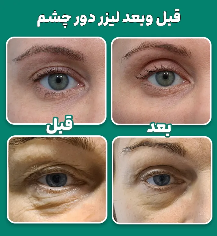 قبل وبعد لیزر دور چشم