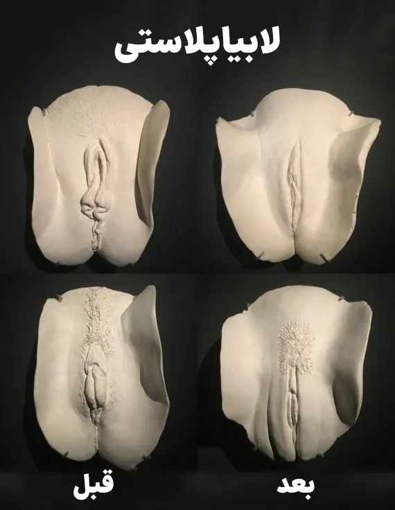 لابیاپلاستی