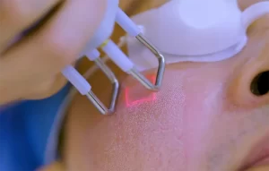 درمان لک صورت با لیزر co2 فرکشنال