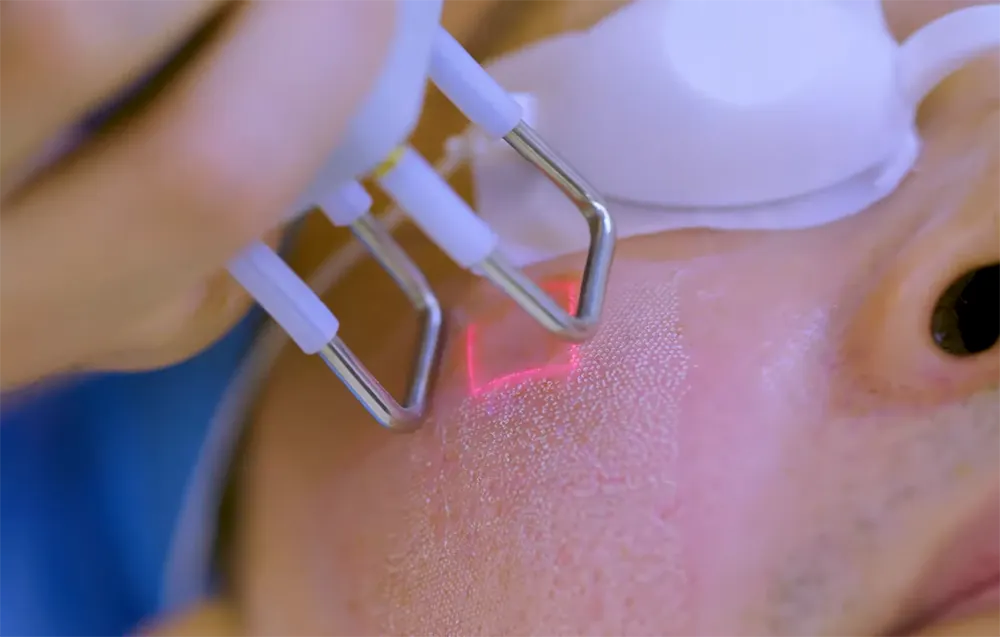 درمان لک صورت با لیزر co2 فرکشنال