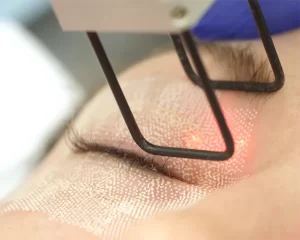 رفع چین و چروک دور چشم با لیزر فرکشنال