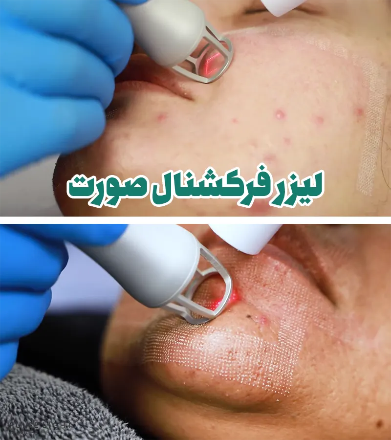 لیزر فرکشنال صورت