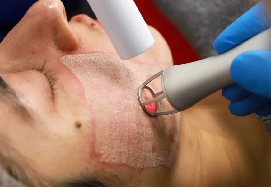 لیزر فرکشنال منافذ باز