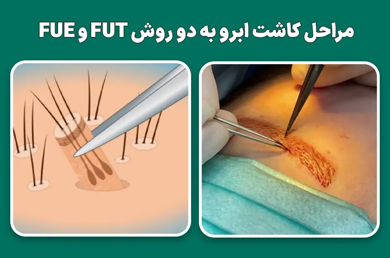 مراحل کاشت ابرو به دو روش FUT و FUE